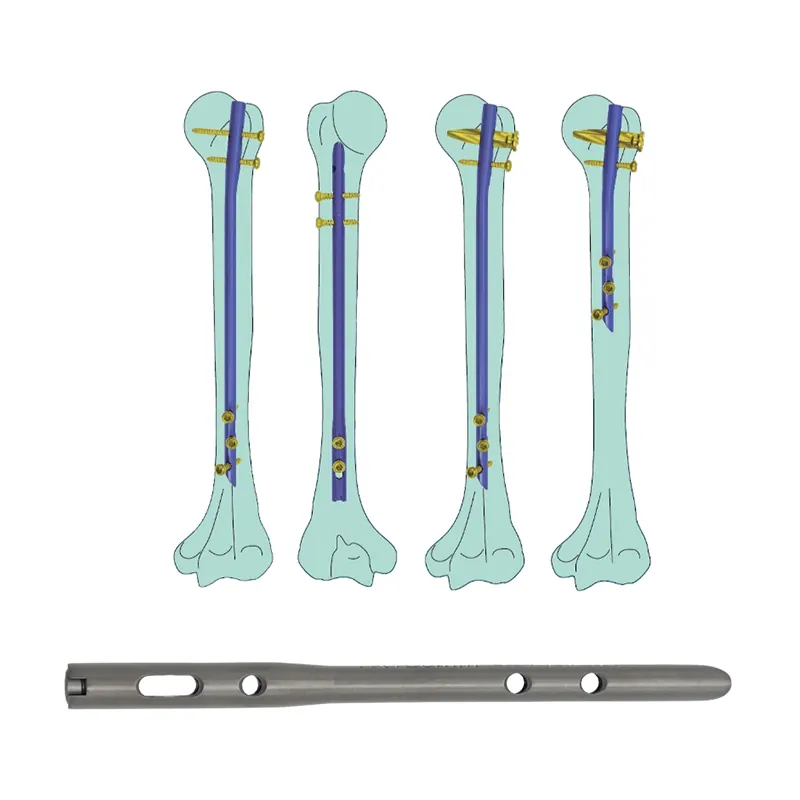 humeral intramedullary nail blade type