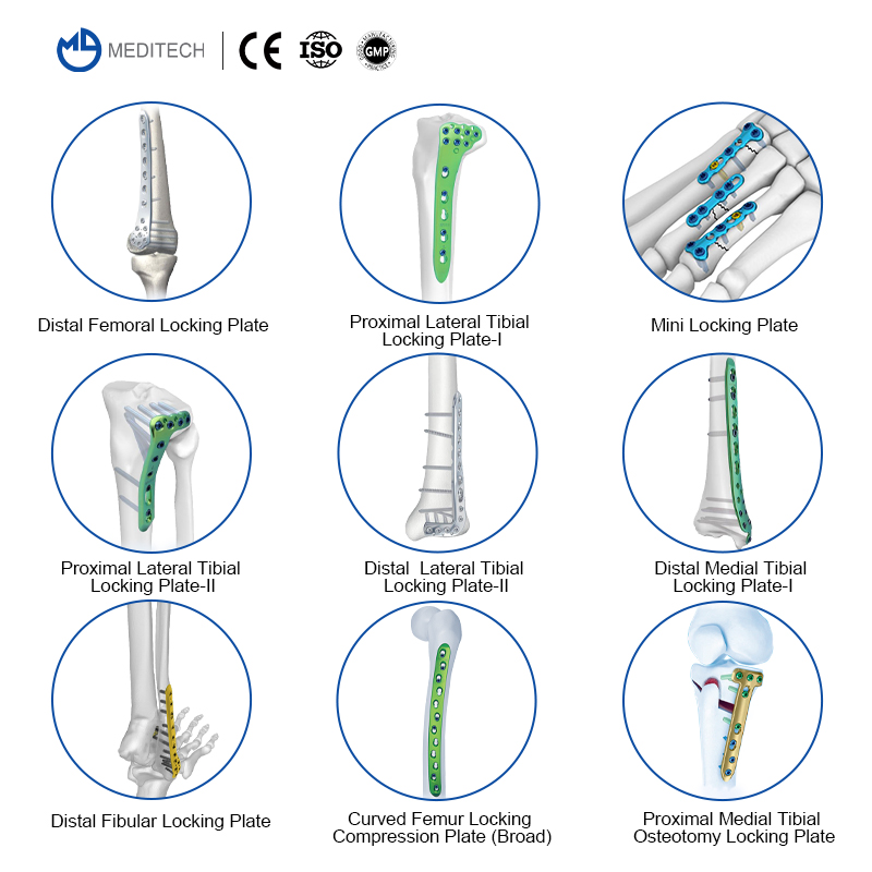 proximal medial tibial osteotomy locking plate