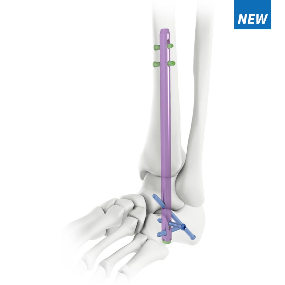 hindfoot fusion ankle nail