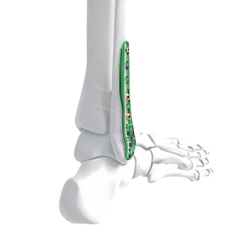 distal lateral fibular locking plate