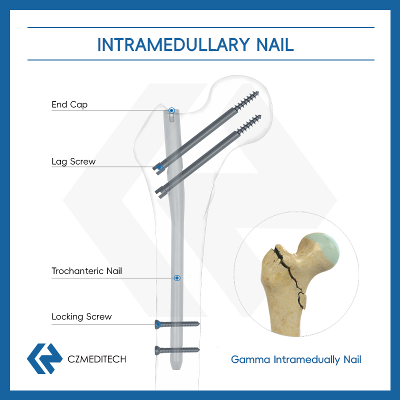 gamma nail