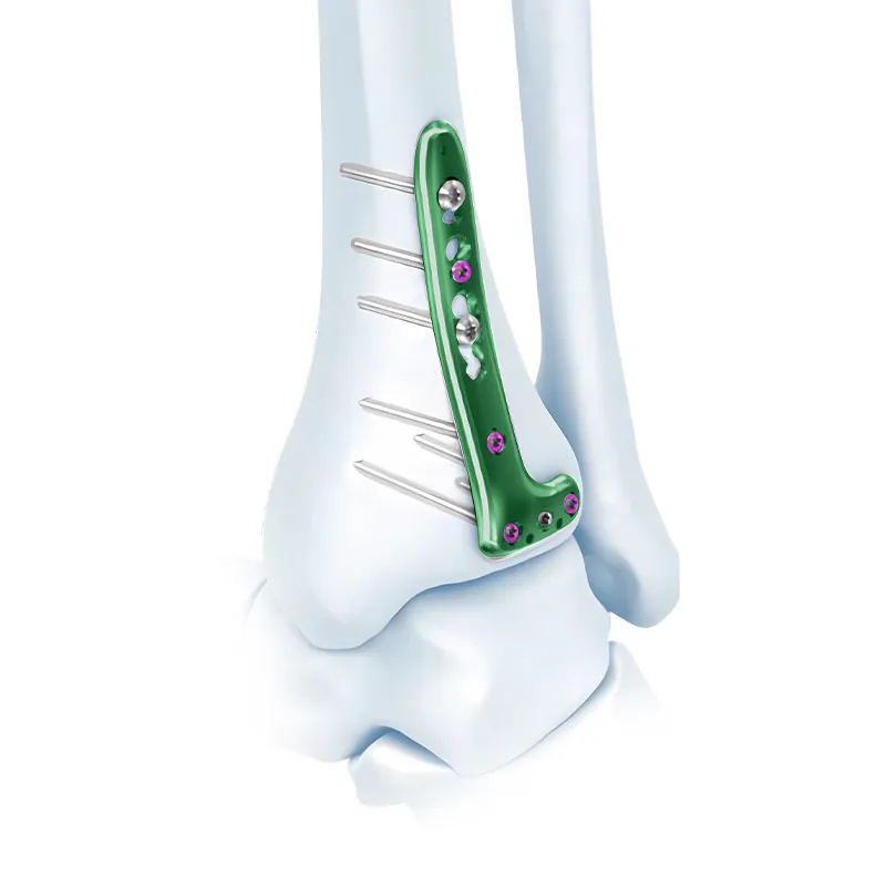 va distal tibia locking l plate