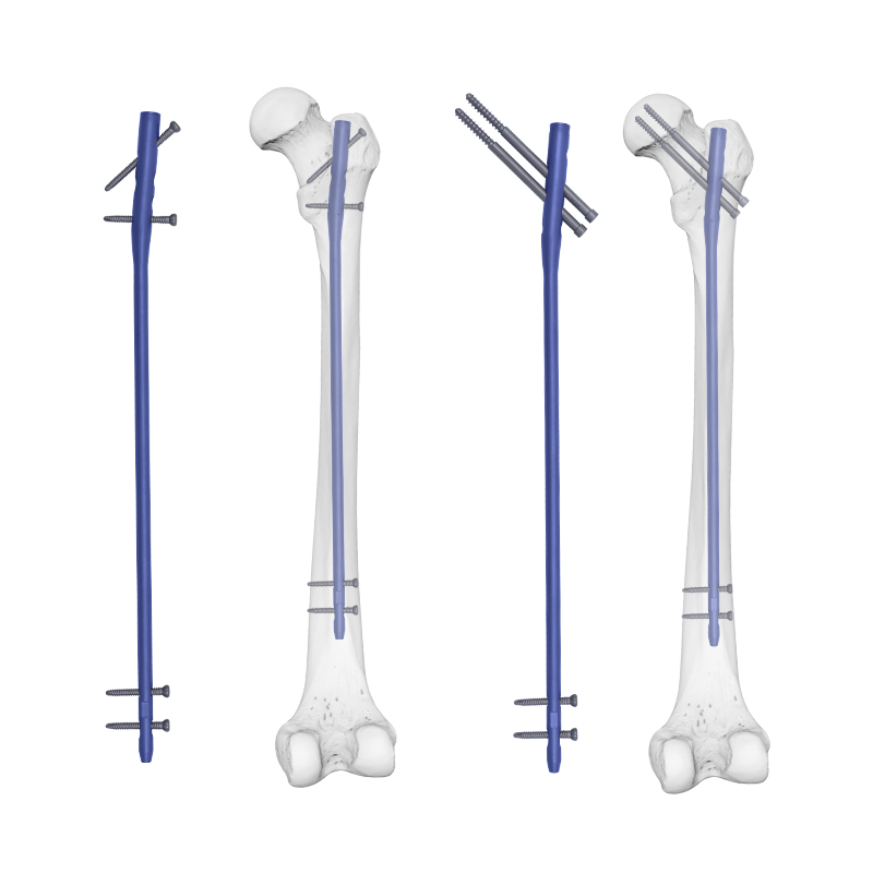expert femoral nail