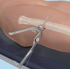 wire cerclage forceps