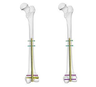 dfn distal femur intramedullary nail t1100 46
