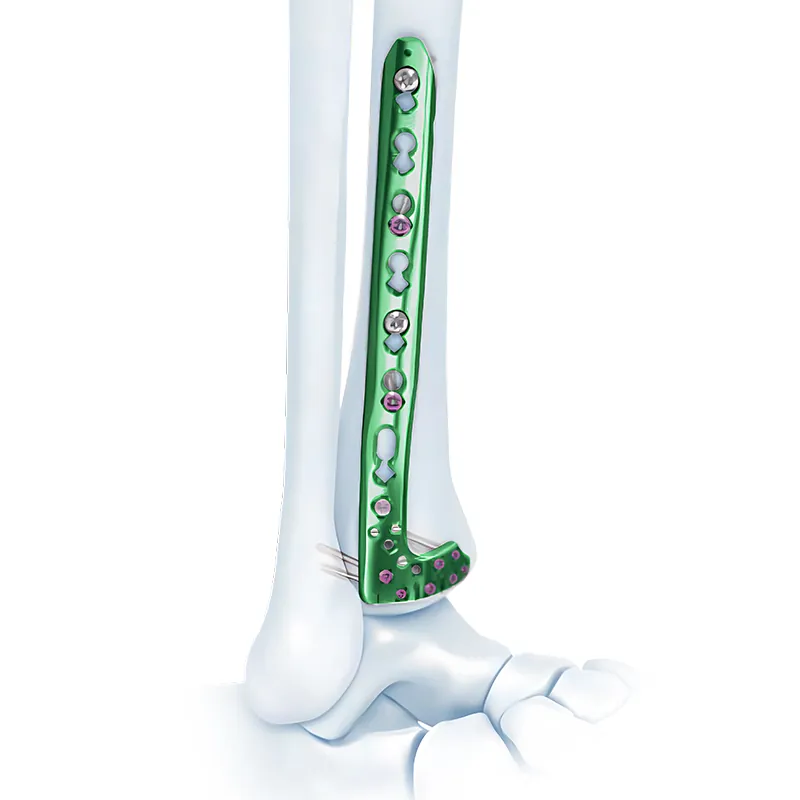 va distal lateral tibia locking plate