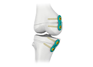 2.7mm LCP Pediatric Straight Plate - 3