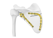 2.7mm LCP Pediatric Straight Plate - 5