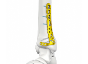 2.7mm LCP Pediatric Straight Plate - 6